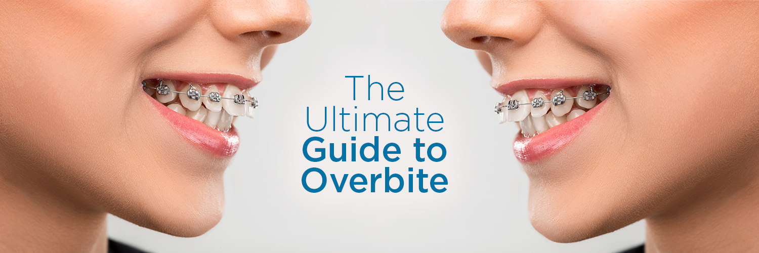 how to fix overbite how to fix overbite